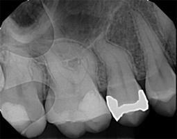 Curved root canal before procedure
