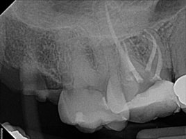 Mesio-Buccal root canal after procedure