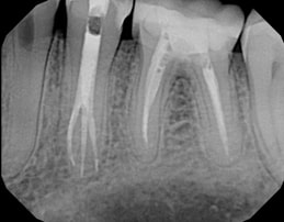 Multiple root canals results